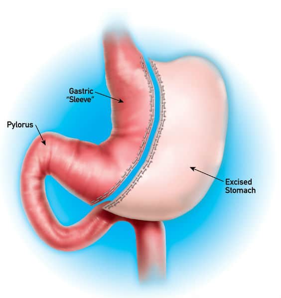 Sleeve Gastrectomy — illustrazione anatomica