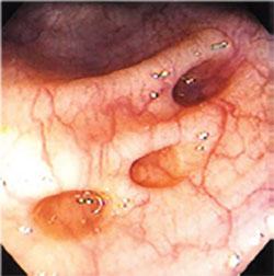 diverticolosi individuata all'esame colonscopico
