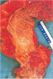 adenocarcinoma ulcerato