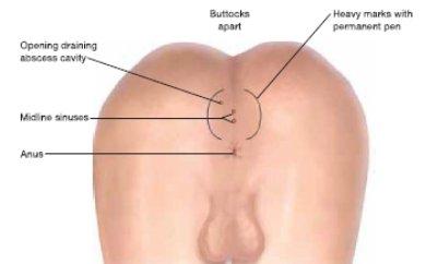 Sinus pilonidalis — anatomia