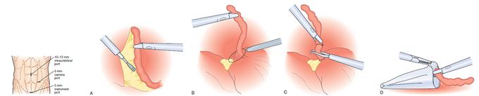 Appendicectomia videolaparoscopica. I tempi chirurgici sono simili a quelli della chirurgia tradizionale, ma con un accesso alla cavità addominale ottenuto mediante tre piccole incisioni comprese tra 5 mm e 1 cm