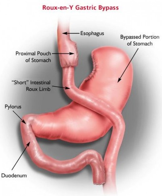 Roux-en-Y Gastric Bypass — illustrazione anatomica
