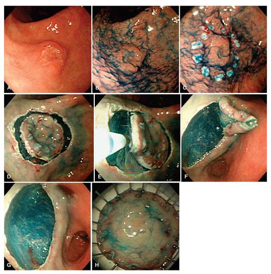 resezione endoscopica ESD di neoplasia early